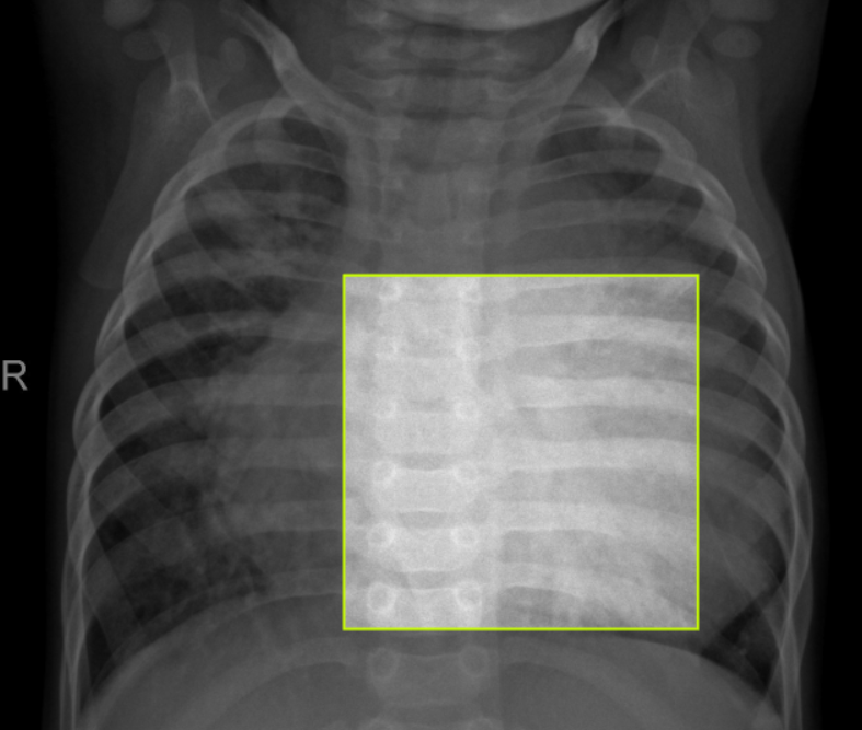 ניתוח תמונות רנטגן (AI)
